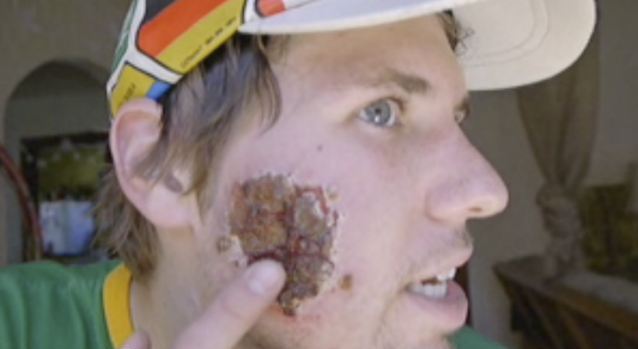 美國(guó)小伙攜女友暢游南美 不幸臉被食肉寄生蟲(chóng)吃出大洞