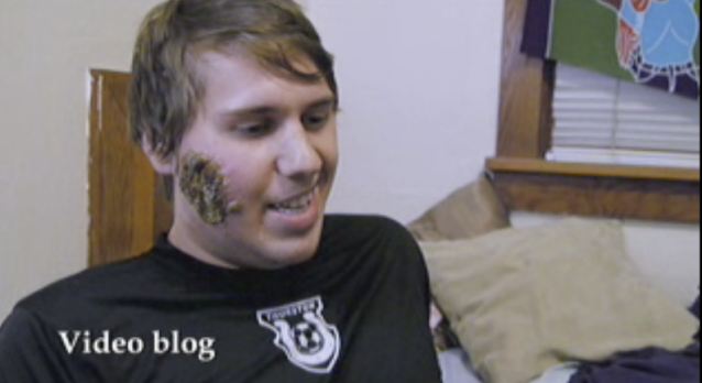 美國(guó)小伙攜女友暢游南美 不幸臉被食肉寄生蟲(chóng)吃出大洞