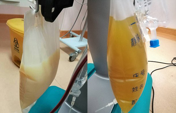 中山男子腹痛緊急送醫(yī)搶救，檢出“牛奶血”！